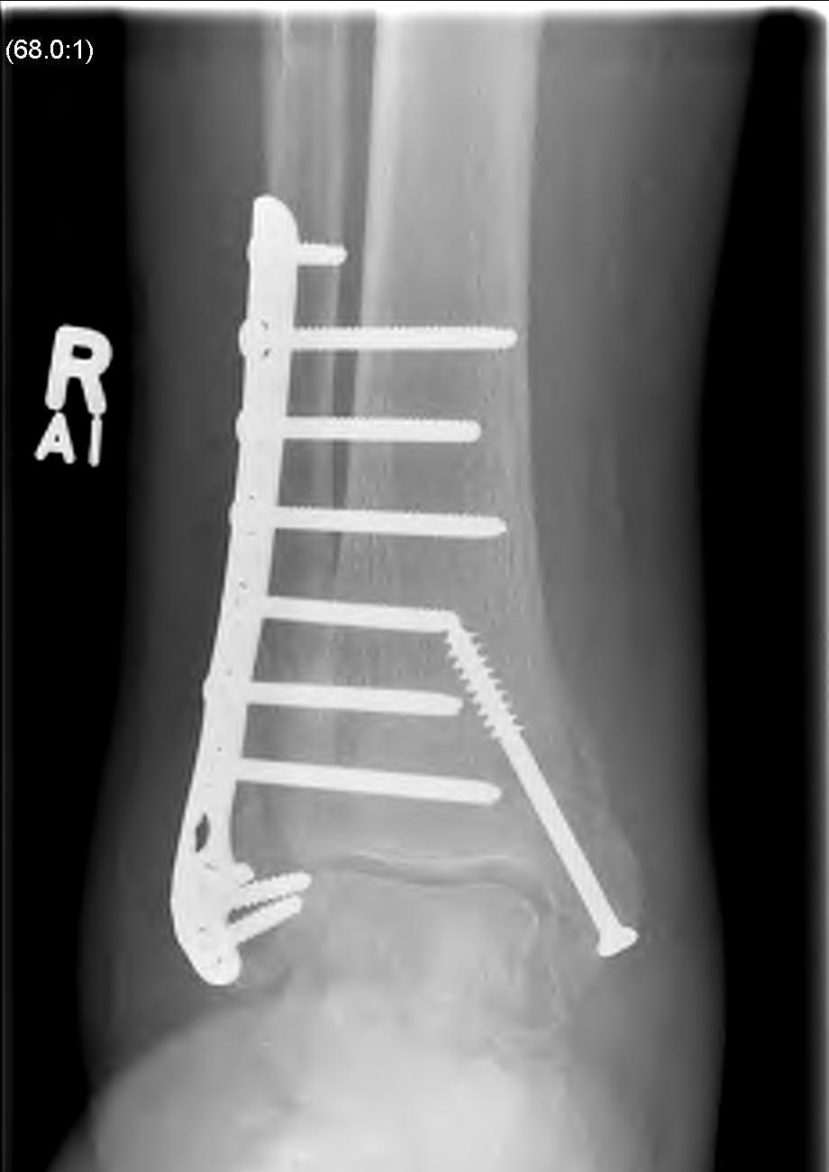 Ankle Osteoporotic Fixation
